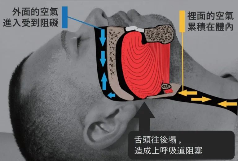 通過這(zhè)樣訓練就(jiù)能改善睡覺打呼噜（轉給需要(yào / yāo)的(de)...）